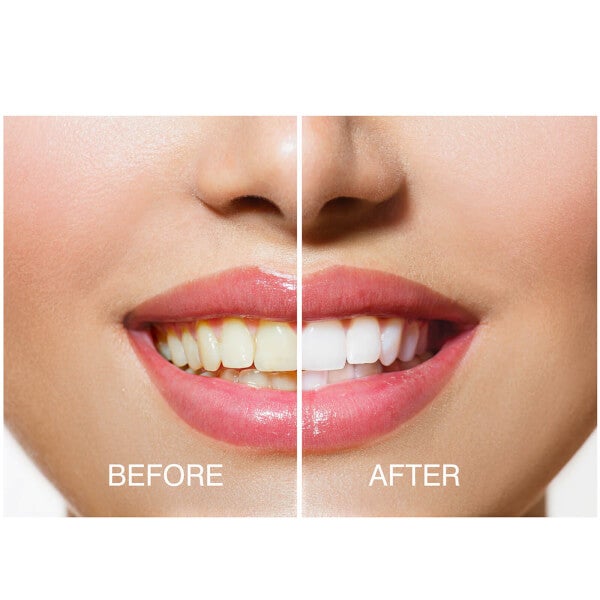 Rio Rio Smile White Advanced Teeth Whitening Kit Latest stili