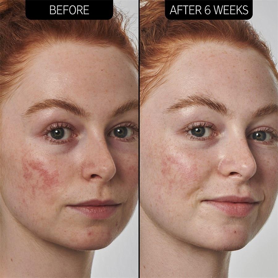 The INKEY List Sieri SuperSolutions 10% Azelaic Acid Serum Super Saving Price